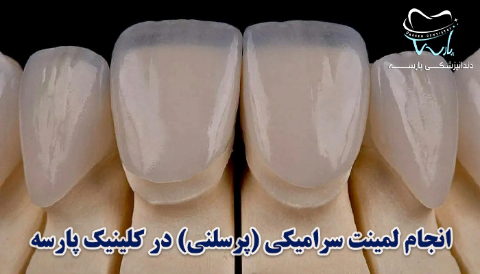 انجام لمینت سرامیکی در کلینیک پارسه