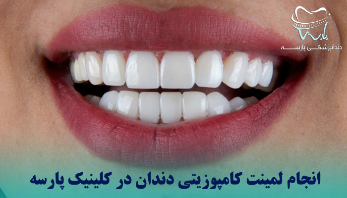 انواع لمینت دندان چیست؟