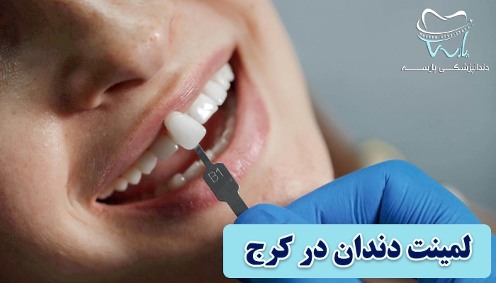 لمینت دندان در کرج چگونه انجام میشود؟