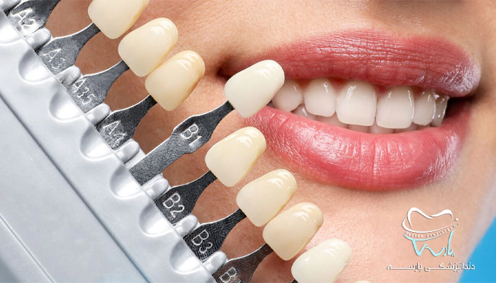 مراحل لمینت کردن دندان