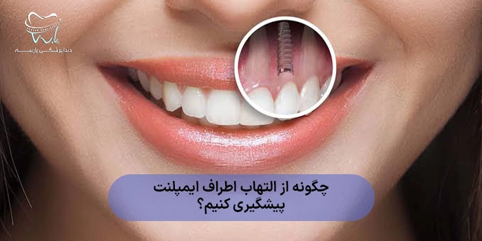 چگونه از التهاب اطراف ایمپلنت پیشگیری کنیم؟