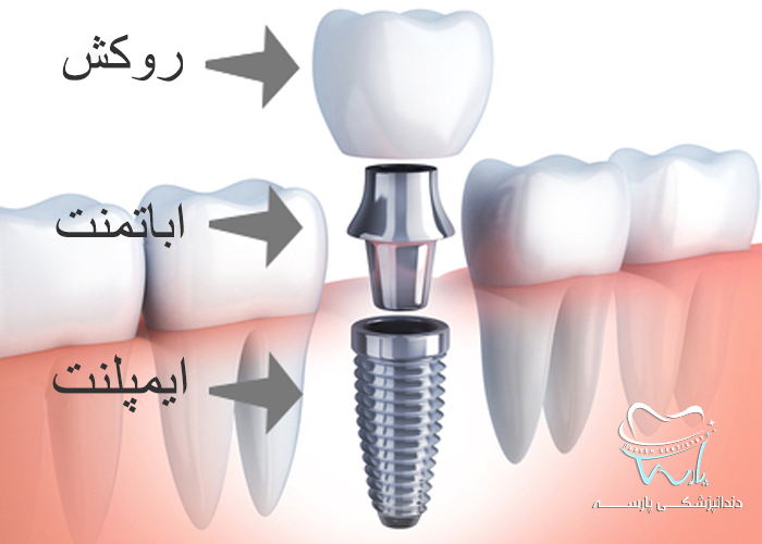 اجزای ایمپلنت دندان