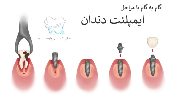 مراحل ایمپلنت دندان