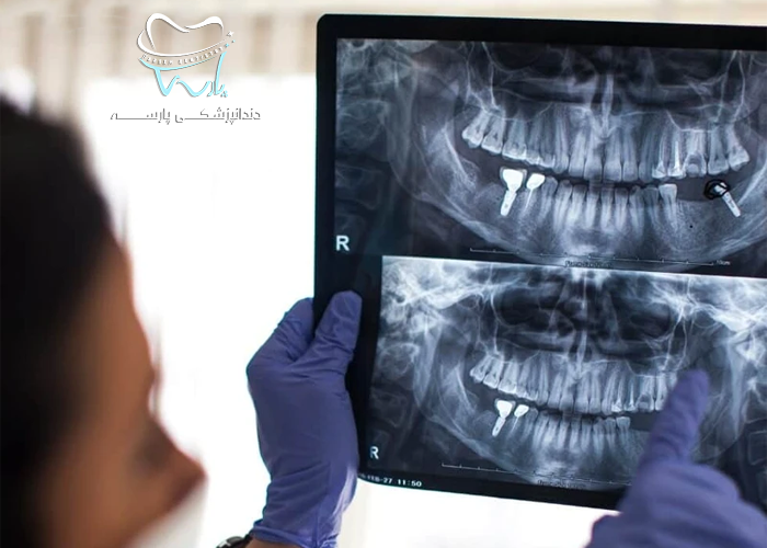 مزایای کاشت دندان (ایمپلنت) چیست