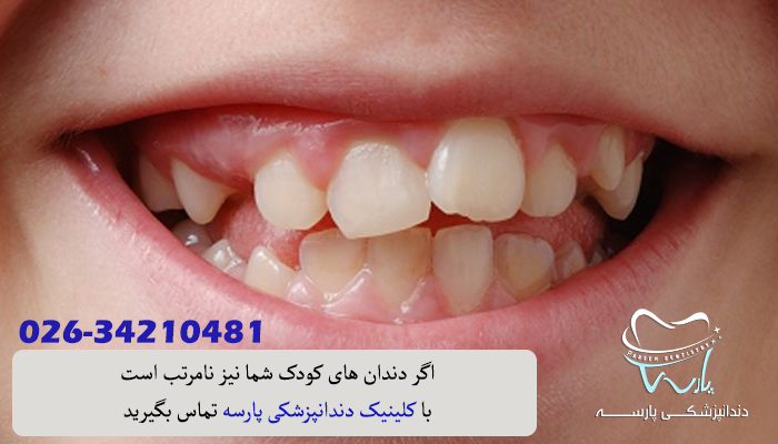 درمان دندان های کج کودکان با ارتودنسی