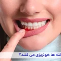 علل خونریزی لثه