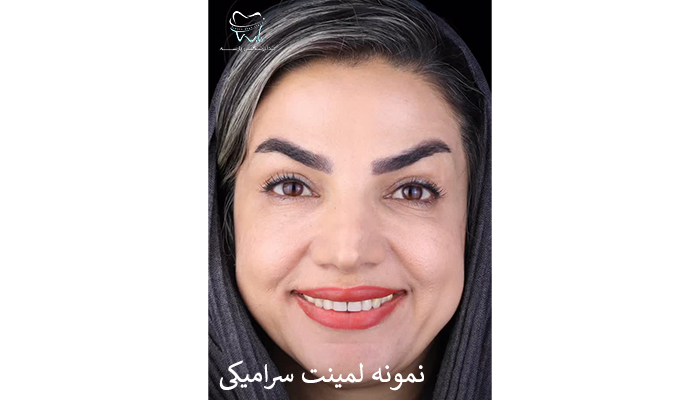 نمونه لمینت سرامیکی