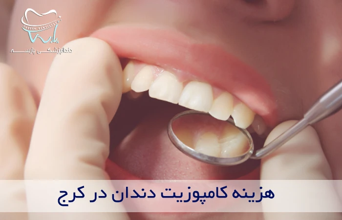 هزینه کامپوزیت در کرج چگونه است؟