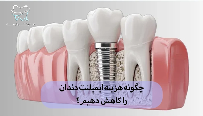 چگونه هزینه ایمپلنت دندان را کاهش دهیم؟