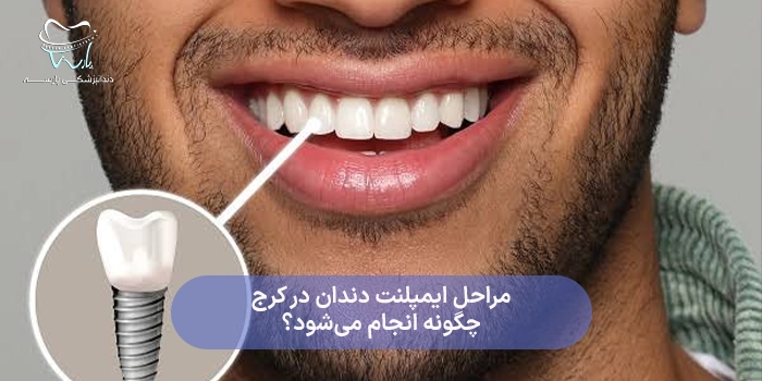 مراحل ایمپلنت دندان در کرج چگونه انجام میشود؟